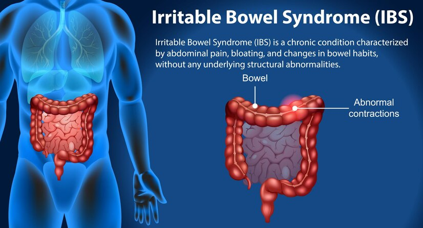 Irritable Bowel Syndrome (IBS