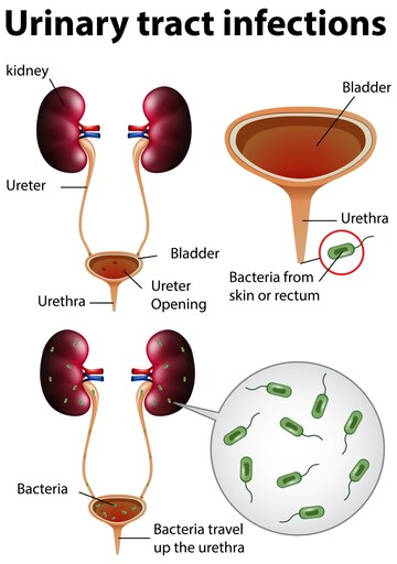 UTI (urinary tract infections atau infeksi saluran kemih)